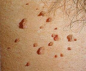 فيروس الورم الحليمي البشري على الجلد